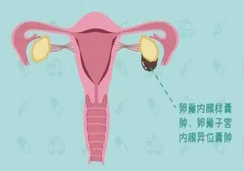 杭州捐卵供卵：﻿试管移植后卧床休息，三天内尽量不上班